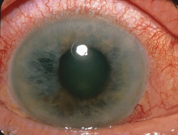Detectar Glaucoma