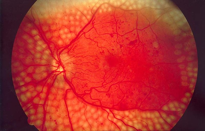 DETECCIÓN DE LA RETINOPATÍA DIABÉTICA A TRAVÉS DE UN SISTEMA DE INTELIGENCIA ARTIFICIAL
