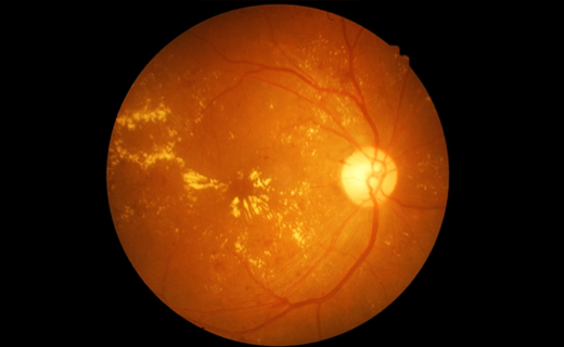 DEGENERACIÓN MACULAR Y FACTORES DE RIESGO LABORAL