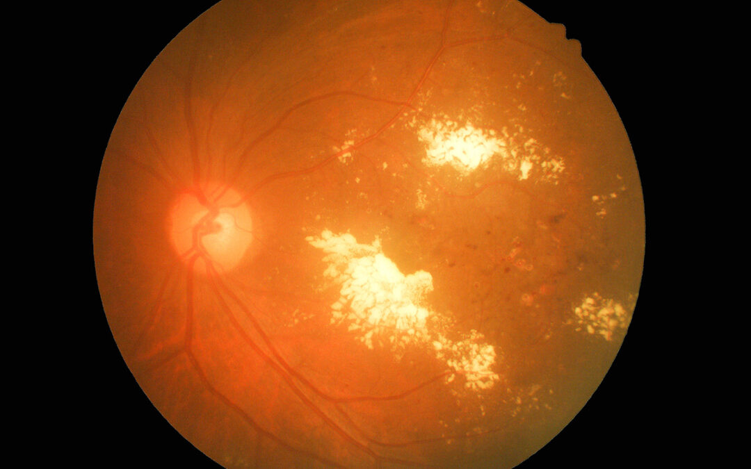 EL PAPEL DE LA INFLAMACIÓN EN LA RETINOPATÍA DIABÉTICA